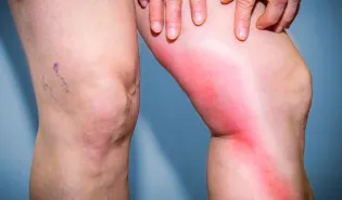 phlebite aux jambes