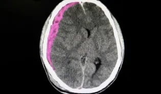 hématome sous dural