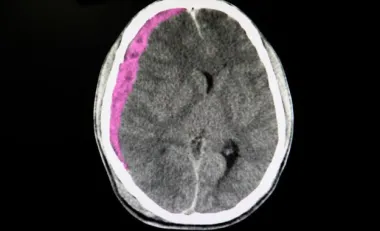 hématome sous dural